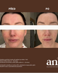 LED Face Mask Diode Therapy Omlazující LED maska na obličej